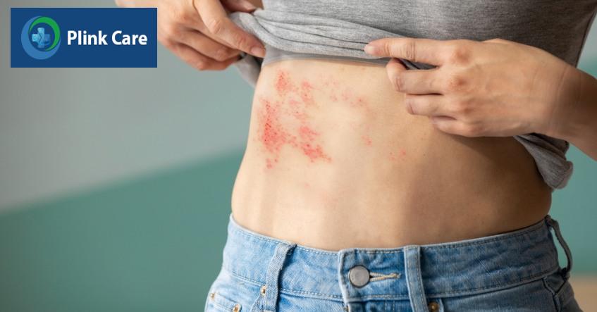 tùy mức độ bệnh zona gây ngứa khác nhau