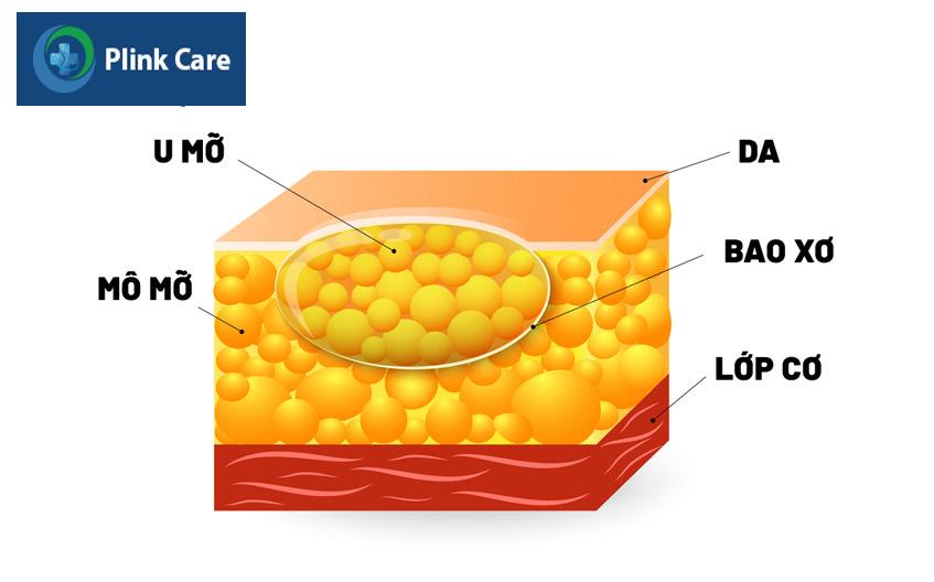 u mỡ là khối u lành tính