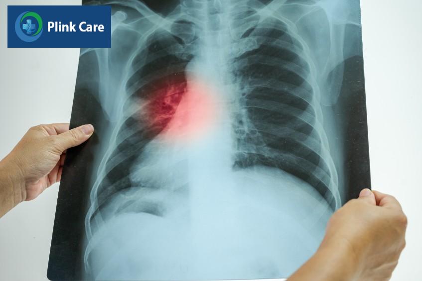Viêm phổi cộng đồng được chẩn đoán dựa trên biểu hiện lâm sàng