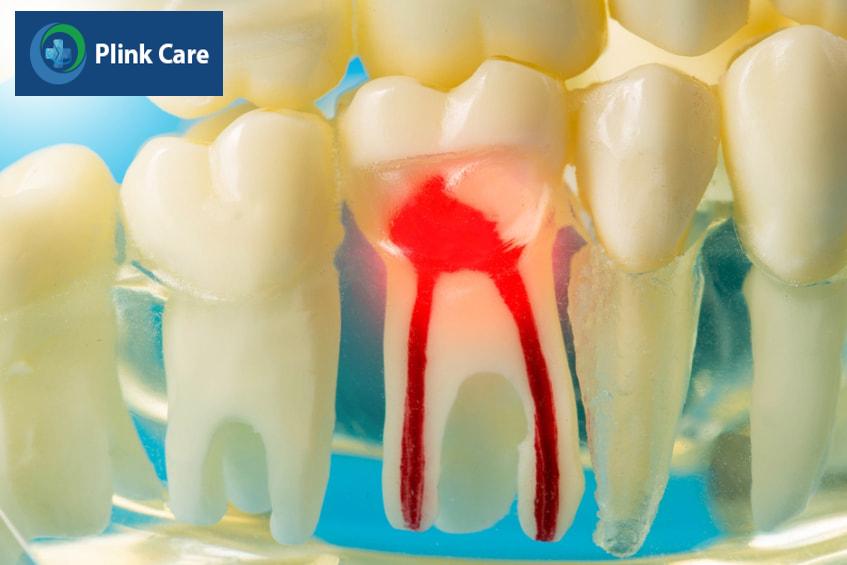Dấu hiệu viêm tủy răng sữa