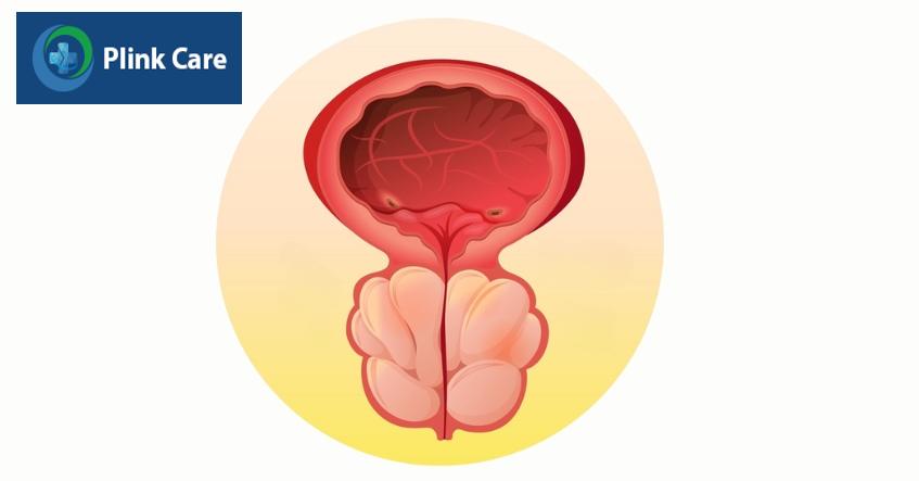 viêm tuyến tiền liệt gây chèn ép đường tiểu